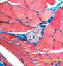 Nerf dans muscle (objectif x100). Localisé entre plusieurs faisceaux de muscles striés squelettiques, et entouré de tissu conjonctif, on observe au centre de la photo, l'image caractéristique en histologie, d'un nerf périphérique en section transversale ; la plupart des noyaux observés appartiennent aux cellules de Schwann. Les gaines de myéline, colorées ici en bleu, entourent les axones.  <br />Coloration trichromique de Masson modifiée : le bleu d'aniline  acétique (qui colore le collagène), remplace le vert lumière.  Les noyaux des cellules sont colorées par l'Hématoxyline de Groat, les  cytoplasmes par un mélange de fuchine acide, ponceau de xylidine, et  donc bleu d'aniline acétique. [27187 views]