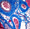 Vaisseaux sanguins, lymphatiques et nerfs (objectif x40). Trois gros vaisseaux sont visibles sur cette portion de coupe, dont la lumière contient des hématies. En haut à gauche, on observe un vaisseau de grand diamètre dont la paroi  est très épaisse, et « crénelée ». Cette paroi est constituée de tissu conjonctif associé à des fibres musculaires lisses. Une tunique de nature conjonctive (bleu) entoure l'ensemble : c'est l'image caractéristique d'une artère musculaire.  Les 2 autres vaisseaux, eux aussi entourés de tissu conjonctif, ont une paroi interne beaucoup plus mince. De ce fait, ces vaisseaux peuvent se déformer (vaisseau du centre bas). On observe également certains  noyaux de l'intima faisant saillie dans la lumière : c'est l'image caractéristique des veines de gros diamètre.  Situé entre ces deux veines, on peut observer une portion de capillaire sanguin, en section longitudinale.  Au dessous, une structure présentant une grande lumière mais sans hématies. La paroi est mince, entourée de fibres de collagène, et quelques noyaux sont visibles dans l'intima : c'est un vaisseau lymphatique. On observe également sur cette coupe, en bas et à gauche, des portions de nerfs coupés dans le sens longitudinal : les fibres nerveuses organisées en faisceaux juxtaposés, et délimitées par du tissu conjonctif, apparaissent colorées en mauve. Elles sont entourées de tissu conjonctif.  Les grandes cellules qui semblent avoir été vidées de leurs contenus sont des adipocytes.  <br />Coloration trichromique de Masson modifiée : le bleu d'aniline  acétique (qui colore le collagène), remplace le vert lumière.  Les noyaux des cellules sont colorées par l'Hématoxyline de Groat, les  cytoplasmes par un mélange de fuchine acide, ponceau de xylidine, et  donc bleu d'aniline acétique. [31615 views]
