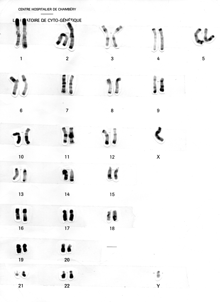 Le caryotype est une technique qui permet l'étude des chromosomes d'un individu.  Tout prélèvement dont les cellules sont en division <em>in vitro</em> permet l'établissement d'un caryotype (lymphocytes T du sang, fibroblastes de la peau, cellules du liquide amniotique, ...). 
Les cellules en multiplication sont traitées avec de la colchicine qui empêche la polymérisation de la tubuline et donc la formation du fuseau mitotique. La mitose est alors bloquée au stade de métaphase. Les cellules subissent ensuite un choc hypotonique qui fragilise les membranes, puis les constituants cellulaires sont fixés grâce à un fixateur. On laisse alors tomber quelques gouttes de la  suspension de cellules sur une lame de verre ce qui fait éclater les membranes, et libère ainsi les chromosomes qui restent toutefois groupés. Diverses techniques de coloration permettent ensuite d'observer les chromosomes en microscopie optique. Classiquement on réalise ensuite une micro-photographie d'un ensemble chromosomique en vérifiant qu'aucun chromosome ne recouvre son voisin (recherche microscopique de la meilleure disposition). Cette photographie, agrandie sur papier, est découpée, manuellement, afin de trier les chromosomes. C'est l'ensemble, trié, numéroté qui est photographié à nouveau et qui constitue le caryotype présenté.<br />
Caryotype <strong>XX</strong> : <strong><a href='https://phototheque.enseigne.ac-lyon.fr/photossql/photos.php?RollID=images&FrameID=caryotypeXX_non-trie'>groupe de chromosomes</a></strong> - <strong><a href='https://phototheque.enseigne.ac-lyon.fr/photossql/photos.php?RollID=images&FrameID=caryotypeXX_trie'>chromosomes triés</a></strong><br /> 
Caryotype <strong>XY</strong> : <strong><a href='https://phototheque.enseigne.ac-lyon.fr/photossql/photos.php?RollID=images&FrameID=caryotypeXY_non-trie'>groupe de chromosomes</a></strong> - <strong>chromosomes triés</strong>