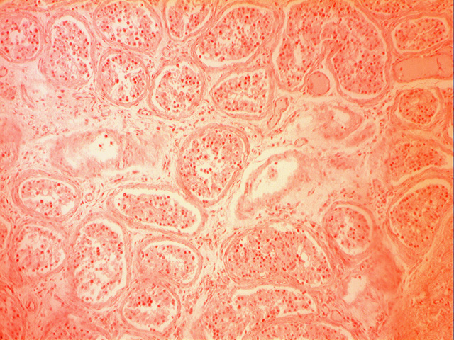 Coupe de testicule d'homme cryptorchide. Le cryptorchidisme est l'une des anomalies les plus fréquentes à la naissance chez les jeunes garçons. Il se définit par l'absence d'un ou des deux testicules dans le scrotum. Il est causé par l'arrêt de la migration du testicule lors de son trajet de descente ; entre la région lombaire où il se forme et son emplacement naturel dans le scrotum. Grossissement x100.
