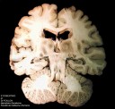 Coupe transversale d'encéphale montrant le cortex et la substance blanche. Organe mis à disposition par le Professeur Foulon. [40367 views]