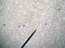 Frottis sanguin après coloration au May Grünwald Giemsa.

Le May Grünwald Giemsa est composé de 3 colorants :<br />
- l'éosine, qui colore en orange certains éléments cellulaires comme l'hémoglobine et les granulations éosinophiles ;<br />
- le bleu de méthylène, qui donne une coloration bleue aux éléments cellulaires sur lesquels il se fixe, comme le noyau ou les granulations basophiles ;<br />
- l'azur de méthylène, qui donne une coloration rouge aux éléments cellulaires sur lesquels il se fixe, comme le noyau ou les granulations azurophiles.<br />
Les noyaux sont tous colorés en violet, mais selon la cellule, les constituants du colorant se fixent différemment sur le cytoplasme et les granulations. Cela permet d'identifier différents types de globules blancs (leucocytes).<br />
Les nombreuses hématies, anucléées, apparaissent en rose-orangé. On distingue un Lymphocyte à son noyau arrondi occupant la majorité de la cellule, au cytoplasme réduit, gris - bleu, sans granulations. Il y a également quatre polynucléaires neutrophiles dont le noyau est segmenté en 2 à 5 lobes, le cytoplasme riche en granulations brunes sur un fond clair discrètement rosé.
 [23786 views]