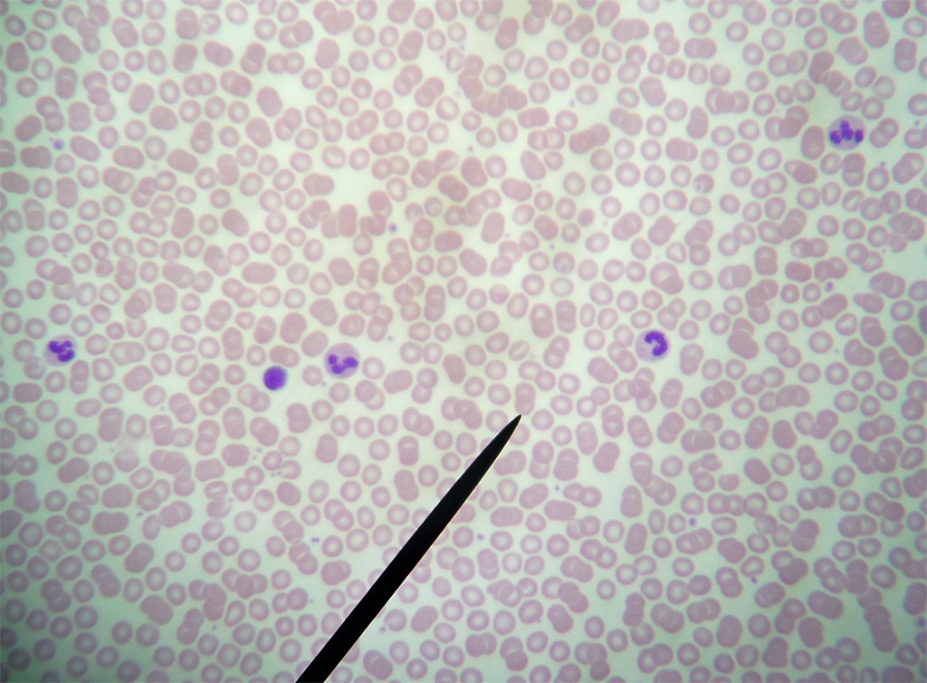 Frottis sanguin après coloration au May Grünwald Giemsa.

Le May Grünwald Giemsa est composé de 3 colorants :<br />
- l'éosine, qui colore en orange certains éléments cellulaires comme l'hémoglobine et les granulations éosinophiles ;<br />
- le bleu de méthylène, qui donne une coloration bleue aux éléments cellulaires sur lesquels il se fixe, comme le noyau ou les granulations basophiles ;<br />
- l'azur de méthylène, qui donne une coloration rouge aux éléments cellulaires sur lesquels il se fixe, comme le noyau ou les granulations azurophiles.<br />
Les noyaux sont tous colorés en violet, mais selon la cellule, les constituants du colorant se fixent différemment sur le cytoplasme et les granulations. Cela permet d'identifier différents types de globules blancs (leucocytes).<br />
Les nombreuses hématies, anucléées, apparaissent en rose-orangé. On distingue un Lymphocyte à son noyau arrondi occupant la majorité de la cellule, au cytoplasme réduit, gris - bleu, sans granulations. Il y a également quatre polynucléaires neutrophiles dont le noyau est segmenté en 2 à 5 lobes, le cytoplasme riche en granulations brunes sur un fond clair discrètement rosé.
