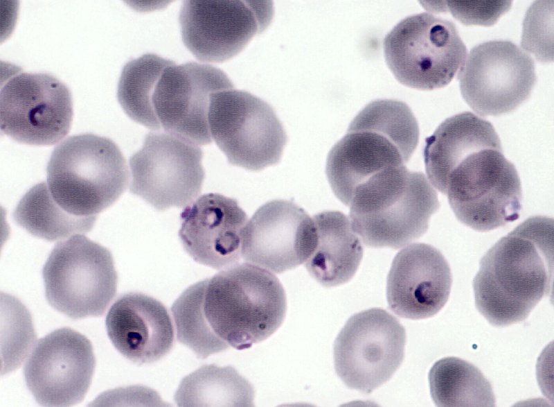 Le paludisme (<em>Plasmodium falciparum</em>, Protozoaires) : hématies polyparasitées par <em>Plasmodium falciparum</em>. Microscopie optique, coloration au MGG (May Gründval Giemsa).