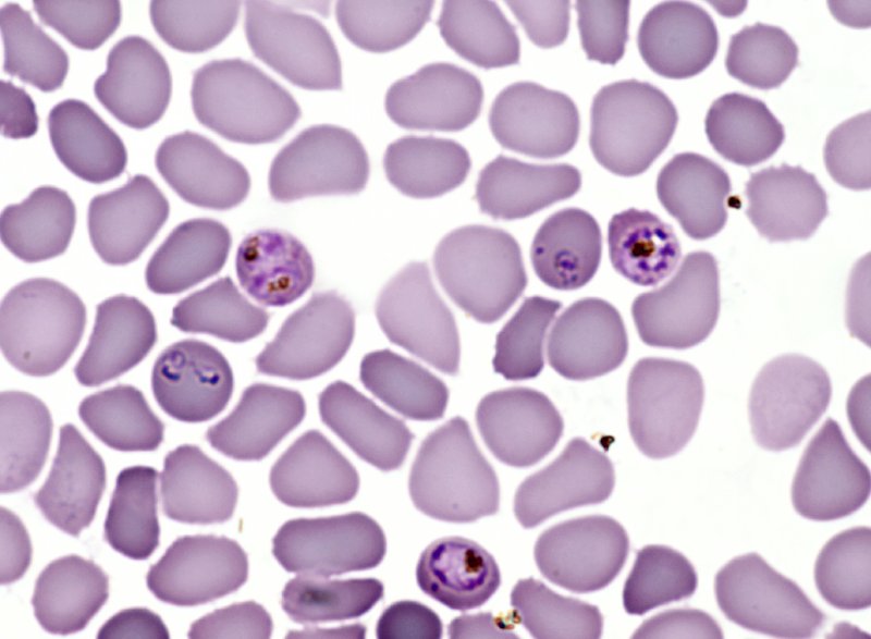 Le paludisme (<em>Plasmodium falciparum</em>, Protozoaires) : <em>Plasmodium falciparum</em> en culture. Microscopie optique, coloration au MGG (May Gründval Giemsa).
