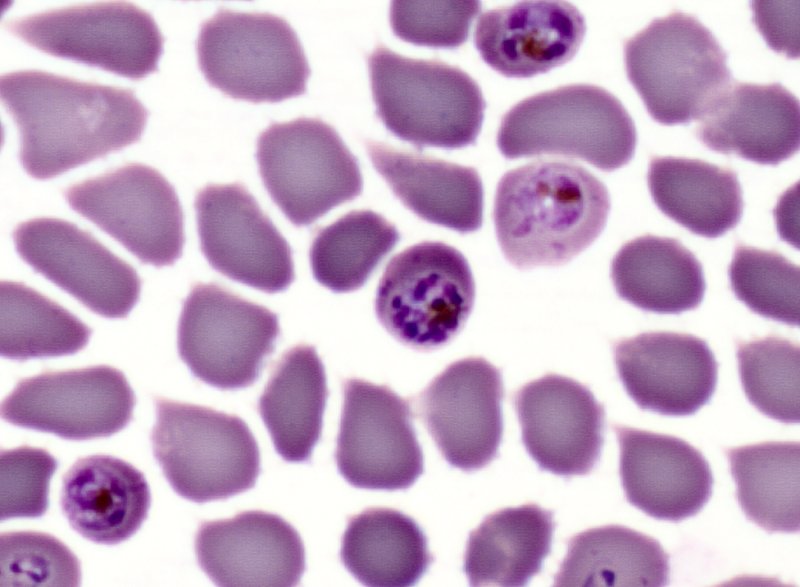 Le paludisme (<em>Plasmodium falciparum</em>, Protozoaires) : schizonte ou "forme en rosace" de <em>Plasmodium falciparum</em>. Microscopie optique, coloration au MGG (May Gründval Giemsa).