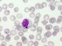 Le paludisme (<em>Plasmodium falciparum</em>, Protozoaires) : hématie parasitée par <em>Plasmodium falciparum</em> phagocytée par un macrophage. Microscopie optique, coloration au MGG (May Gründval Giemsa). [15925 views]