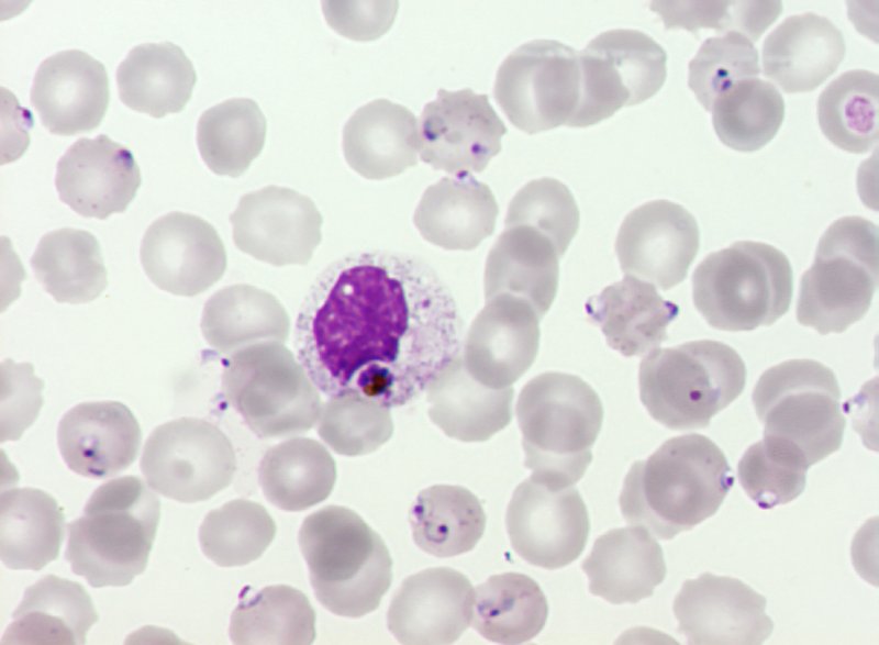 Le paludisme (<em>Plasmodium falciparum</em>, Protozoaires) : hématie parasitée par <em>Plasmodium falciparum</em> phagocytée par un macrophage. Microscopie optique, coloration au MGG (May Gründval Giemsa).