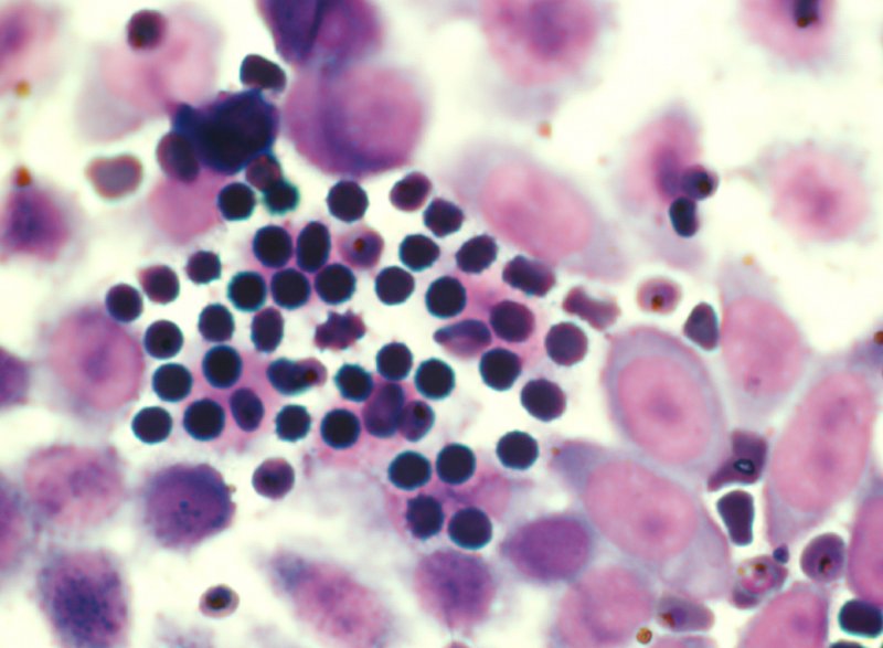 Le paludisme (<em>Plasmodium falciparum</em>, Protozoaires) : séquestration endothéliale de <em>Plasmodium falciparum</em>. Microscopie optique, coloration au MGG (May Gründval Giemsa).